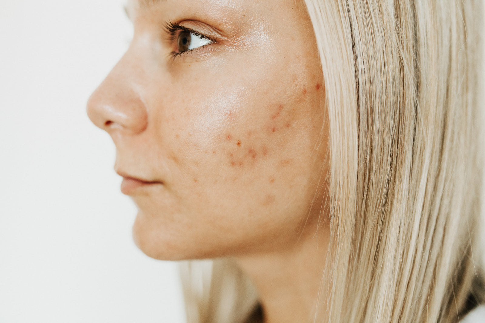 Healing acne with Rachelle & Biologique Recherche